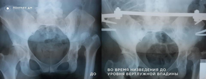 Врожденный вывих левого бедра