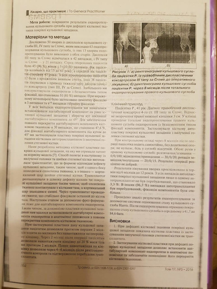Использование костной пластики при эндопротезировании тазобедренного сустава