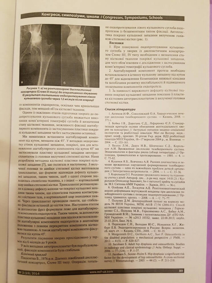 Место костной пластики кровли тазобедренной впадины при эндопротезировании тазобедренного сустава