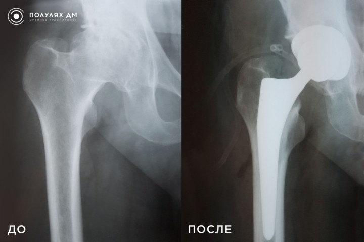 Правосторонний коксартроз