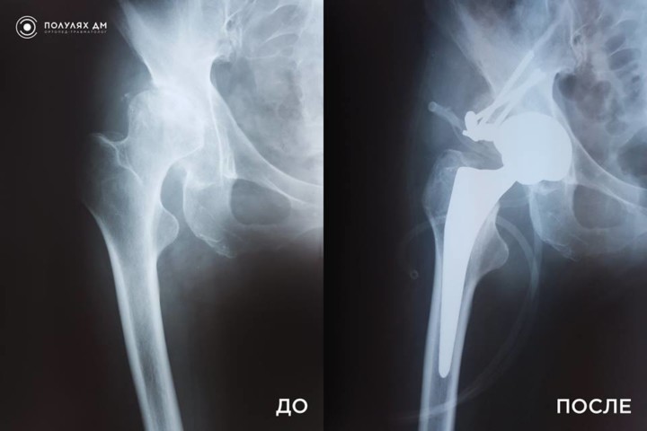 Ревматоидный артрит